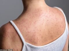 Wabah campak melanda sekolah-sekolah dan taman kanak-kanak di London utara dan lebih dari 60 anak terinfeksi