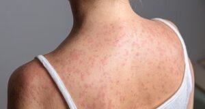 Wabah campak melanda sekolah-sekolah dan taman kanak-kanak di London utara dan lebih dari 60 anak terinfeksi