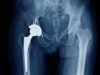 Operasi penggantian pinggul dan lutut NHS DIBATALKAN karena kekurangan semen tulang yang digunakan untuk implan yang mengubah hidup