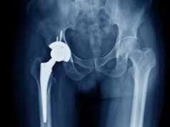 Operasi penggantian pinggul dan lutut NHS DIBATALKAN karena kekurangan semen tulang yang digunakan untuk implan yang mengubah hidup