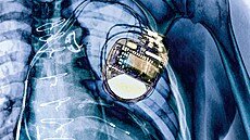 Percayalah, itulah intinya. Mengapa kasus Olomouc dengan defibrilator harus diselidiki dengan baik